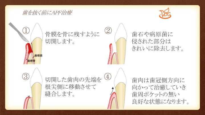 抜歯する前に考えてみましょう「APF法」