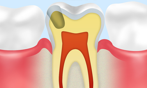 天然歯をできるだけ残すための虫歯治療ドックスベストセメント