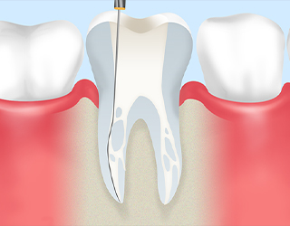 −抜歯を避けるための根管治療−