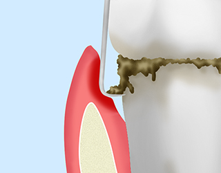 歯周ポケット掻爬（そうは）術